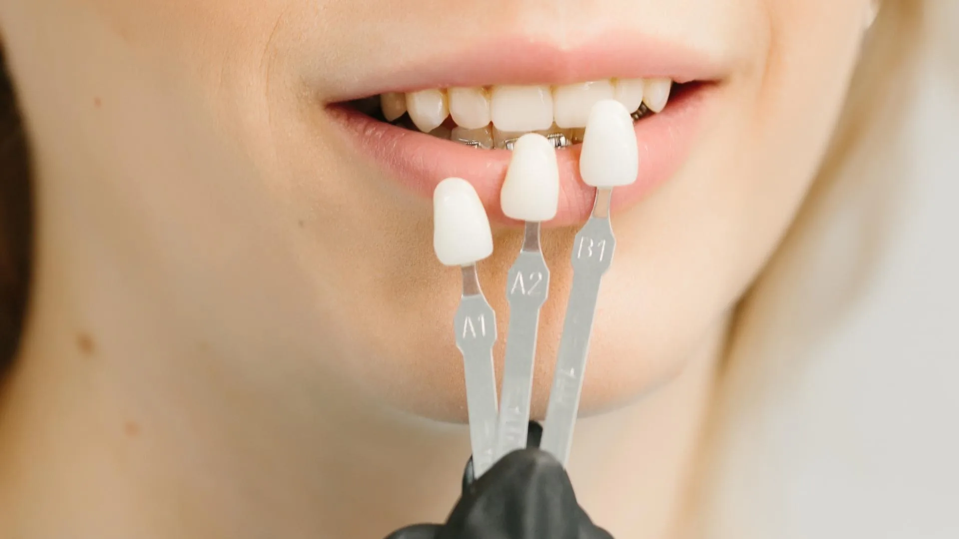 Guía de tonos dentales A1, A2 y B1 para elegir el color de las carillas dentales
