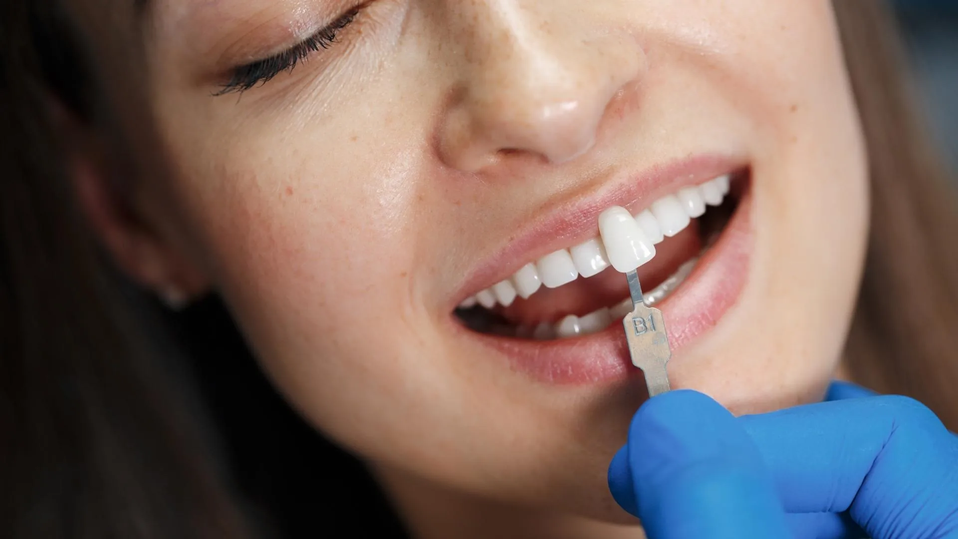 Prueba de ajuste de una carilla dental de porcelana tono B1