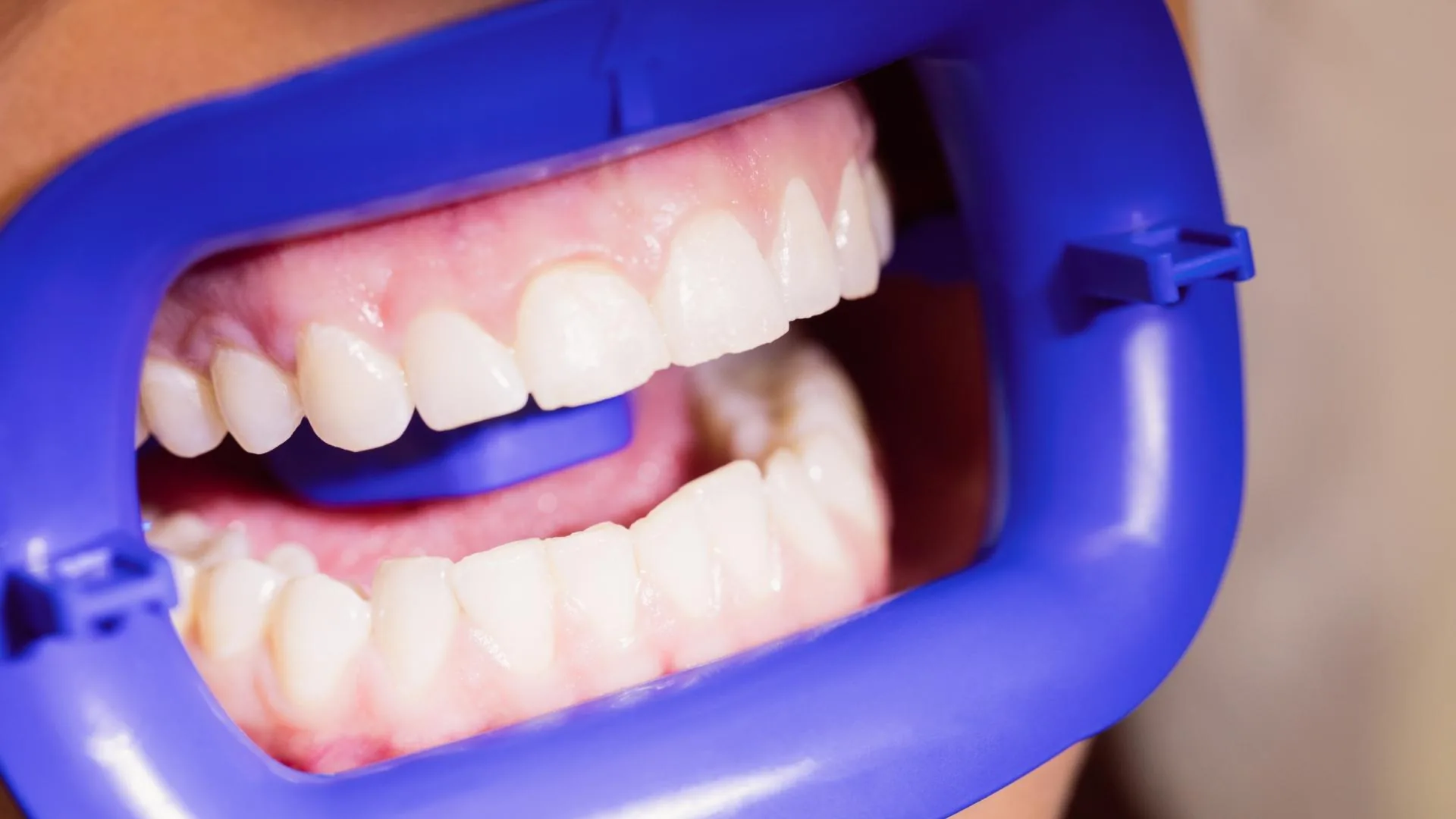 Resultado de carillas dentales tras el tratamiento con abrebocas