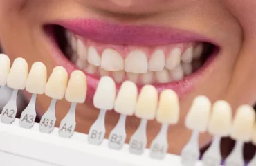 cuanto-duran-las-carillas-dentales-tonos-porcelana Comparativa de tonos de carillas dentales de porcelana antes de la colocación