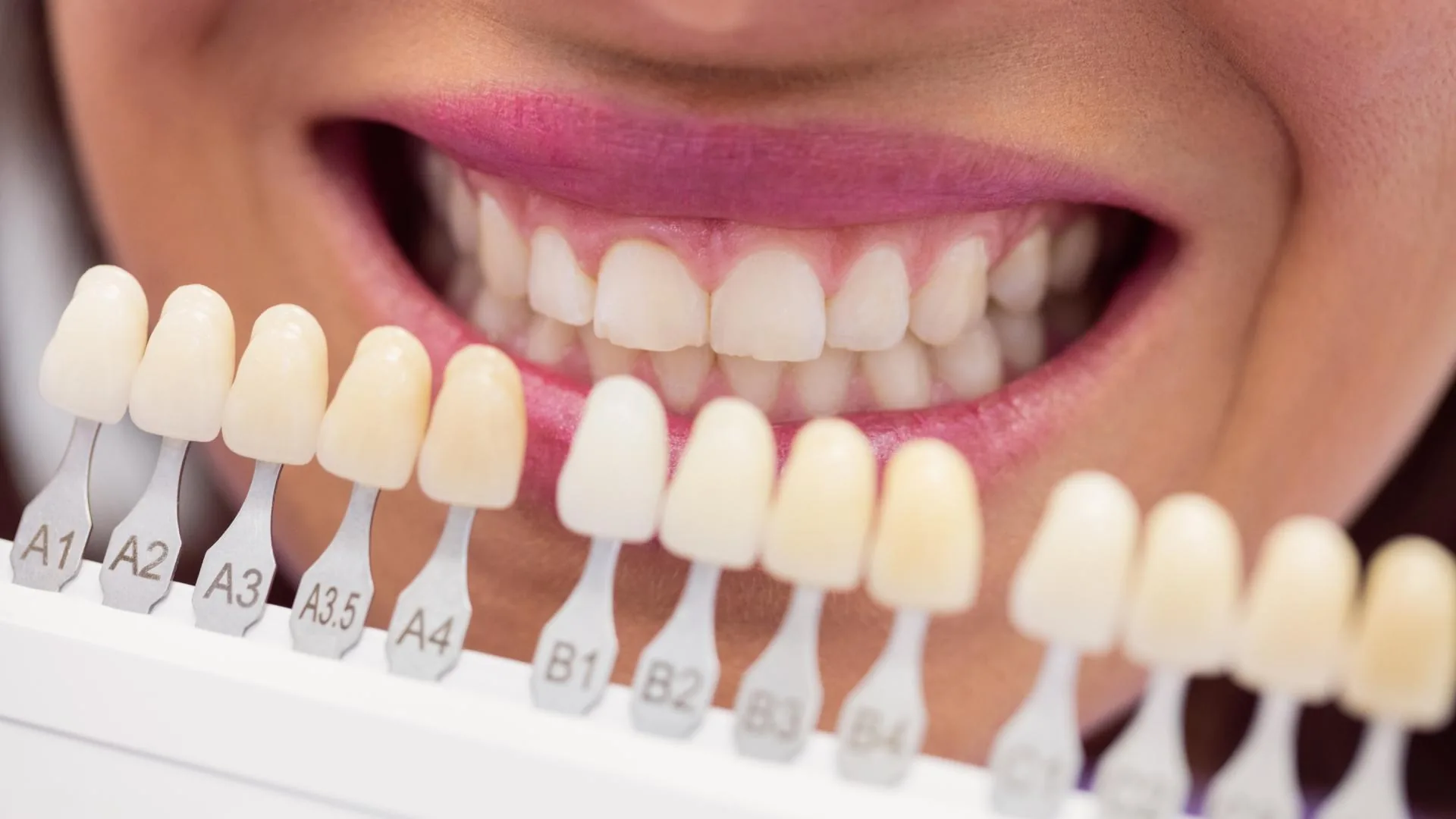 Comparativa de tonos de carillas dentales de porcelana antes de la colocación